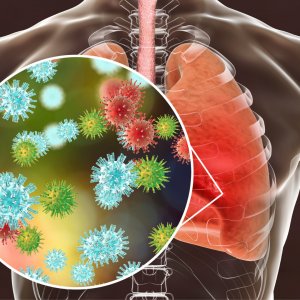 Zatürre Hastalığı Hakkındaki Detaylar