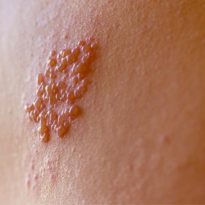 Zona Nedir Nasıl İyileşir?