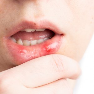 Aft Nasıl İyileşir?