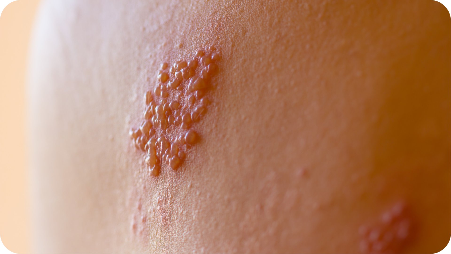 Zona Nedir Nasıl İyileşir?